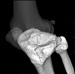 膝関節3D