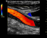 頸部動脈エコー